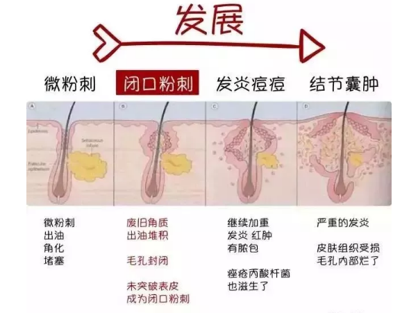 3、已经长痘红肿、发炎，需要借助药品控制