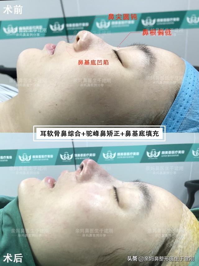 【耳软骨鼻综合+驼峰矫正+鼻基底填充】术后反馈