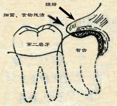 如果不慎发生急性冠周炎我们该如何做呢？