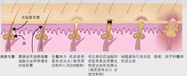 对付白头粉刺最有效的三种方法：