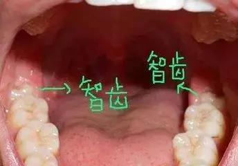 智齿拔除痛不痛？